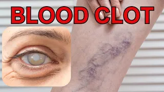The Harmful Effects That Blood Clots Cause Us And How To Dissolve Blood Clots In The Body