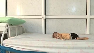 The tiny bodies ravaged by starvation in Yemen's forgotten war