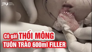 CẬN CẢNH: Bác sĩ Tú Dung NẠO FILLER cho cô gái THỐI MÔNG, sau khi BẠN THÂN tiêm TẠI NHÀ