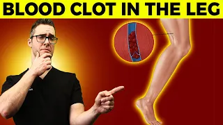 Blood Clot in the Leg or Foot? [Symptoms, Signs, Causes & Treatment]