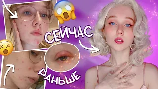 Я СДЕЛАЛА ЭТО и вылечила ПРЫЩИ 😍 Лечение, питание, уход / Мой опыт