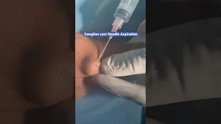 Ganglion cyst of wrist treatment with needle aspiration (Nonsurgical Treatment)