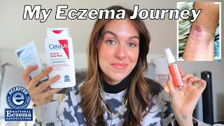 HOW I BEAT MY ECZEMA FOR GOOD // My journey, product recommendations, + body care tips | Rudi Berry