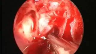 Optic nerve decompression under endoscopic