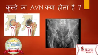 AVN ( Hindi) Hip Joint Pain