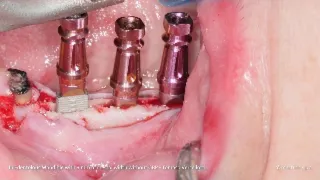 IMPLANTOLOGY - REX CASE REPORT - Implant in Edentolous Mandible, 3 mm crestal width - T.Vercellotti