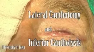 Canthotomy