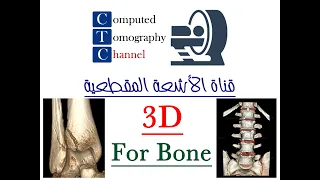 شرح طريقة عمل 3D للعظام ( سواءً كان العظام محاط بالجبيرة او لا ) على جهاز GE