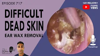 717 - Difficult Dead Skin Ear Wax Removal