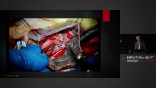 Surgical Repair of Atrial Septal Defects - Mr Simon Moten