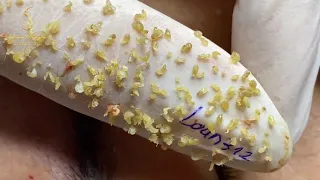 Blackheads removal (312_2) | Loan Nguyen