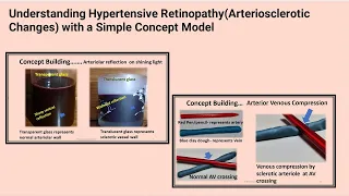 Understanding Hypertensive Retinopathy(Arteriosclerotic Changes) with a Simple Concept Model