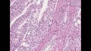 Histopathology Prostate--Adenocarcinoma (Gleason grade 4)