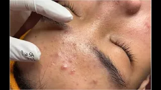 Satisfying And Relaxation with NaSa Beauty Spa #44  blackhead and acne extraction
