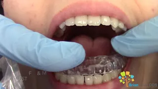 Night Guard for teeth 🛡️ -How it's made and fitted.