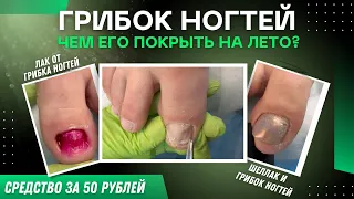 Грибок ногтей / Чем его покрыть на лето? / Средство за 50 рублей / Лак от грибка ногтей / Шеллак