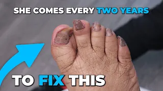 SUPER THICK TOENAIL