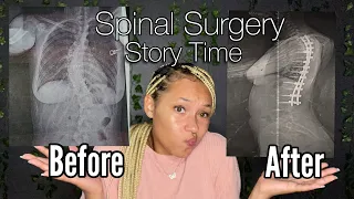 My spinal surgery experience | Scoliosis at 14 yrs old 🤯