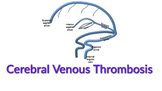 Cerebral Venous Thrombosis || Cortical Venous Thrombosis