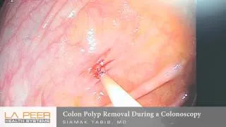 Colon Polyp Removal During Colonoscopy | Los Angeles La Peer Surgery Center