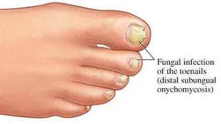 How To Soften Thick Toenails