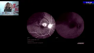 AIOC2019 - IC003 - Infectious posterior uveitis: diagnostic and therapeutic challenge