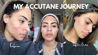 HOW I CLEARED MY CYSTIC ACNE | MY ACCUTANE JOURNEY *depression + side effects*
