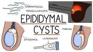 Understanding Epididymal Cysts