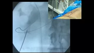 PCNL Access with Fluoroscopy   Triangulation Technique