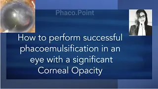 How to perform successful phacoemulsification in an eye with a significant corneal opacity