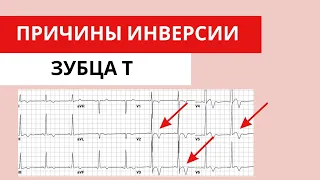 Инверсия зубца Т. Ишемия миокарда и другие причины. Нарушение процессов реполяризации.