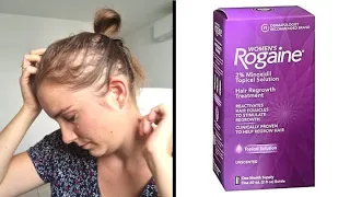 MINOXIDIL/ROGAINE & ALOPECIA: My 10 years treatment experience review