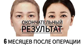 6 МЕСЯЦЕВ ПОСЛЕ ОПЕРАЦИИ: ОКОНЧАТЕЛЬНЫЙ РЕЗУЛЬТАТ. JW Plastic Surgery