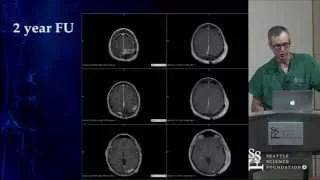 Treatment of Dural Arteriovenous Fistulas by Cameron McDougall, M.D.