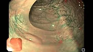 Hyperplastic Colon Polyps