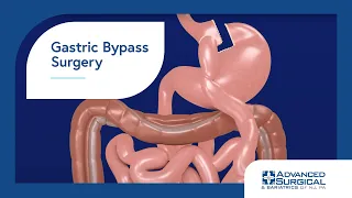 Gastric Bypass 3D Animation