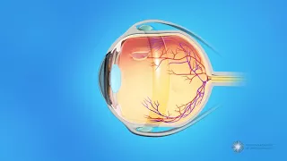 What is scleral buckle surgery?