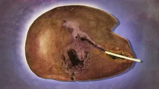 A Man Ate Suspicious Fish For Dinner. This Is What Happened To His Liver.