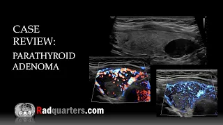 Ultrasound of Parathyroid Adenoma