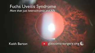 Fuchs Uveitis Syndrome - The Clinical Features - More than Heterochromia and KPs