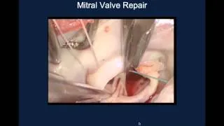 Webinar Playback - The Importance of Mitral Valve Repair Surgery for Patients