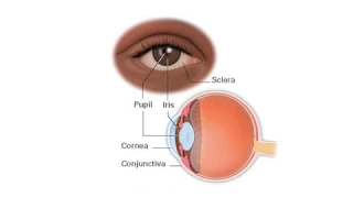 Corneal Causes of Red Eye