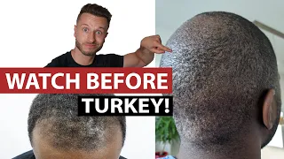 Afro FUE Hair Transplant Turkey - 3 Things to Watch Out For!