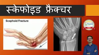 Scaphoid Fracture , All you want to know (Hindi)  स्केफोइड फ्रैक्चर
