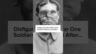 Disfigured World War One Soldiers Before and After #ww1 #warshorts #warhistory #military