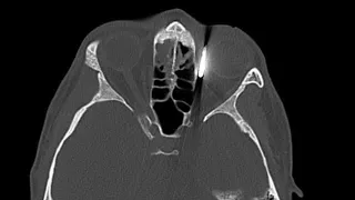 Orbital Foreign Body Removal