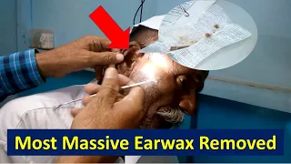 The Most Massive Earwax Removed | Extreme Ear Wax Removal