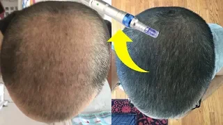 BEST MICRONEEDLING DEVICE FOR HAIR GROWTH!