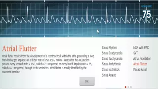 Atrial Arrhythmias (NSR, Atrial Flutter, Atrial Fibrillation)