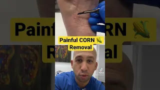 Foot CORN 🌽 Removal 🔪 #shorts